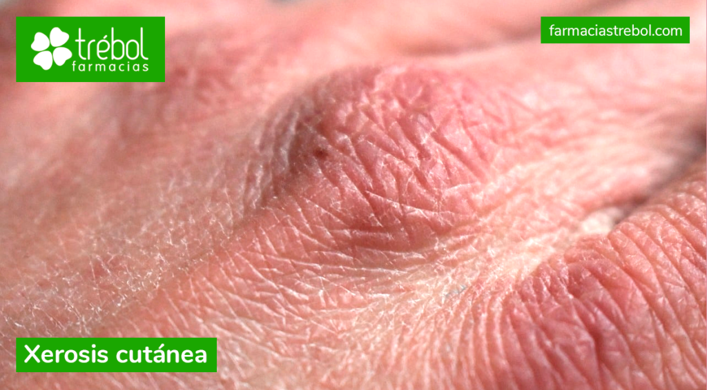 Xerosis cutánea qué es y por qué se produce Farmacias Trébol