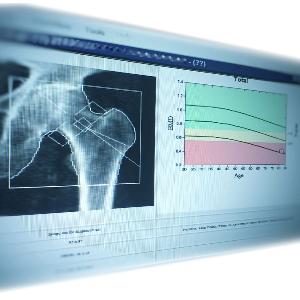 Densitometría - Farmacias Trébol